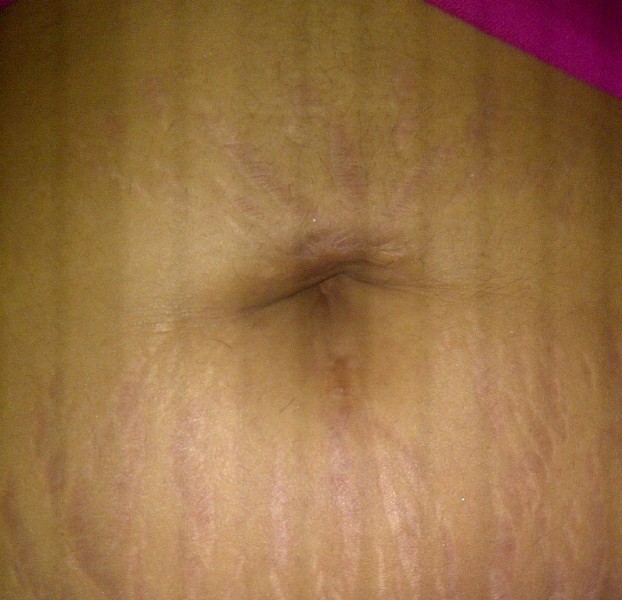 Scars from multiple navel piercings