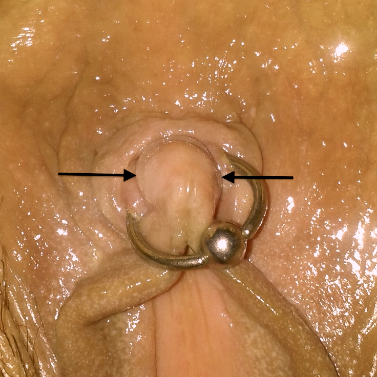 Arrows indicating where the poorly placed clitoris piercing should have been located