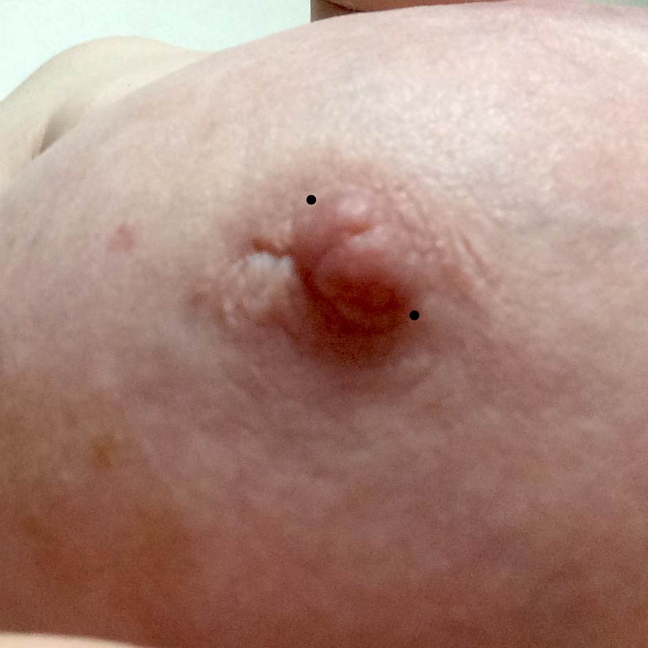 Another scarred nipple marked with alternative (diagonal) placement to avoid scar tissue