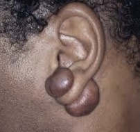 Keloid on earlobe from piercing Thumbnail