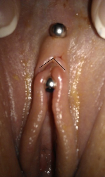Marked Inverted-V of the hood on accidental clitoris piercing.