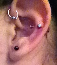 Forward Helix healing