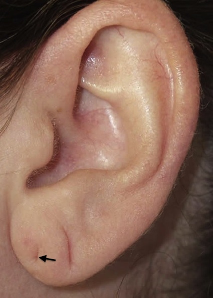 Arrow shows poor placement of ear piercing in infancy