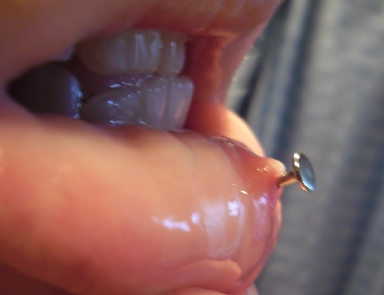 Labret piercing: scar tissue on interior