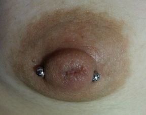 Nipple pierced with too short bar.