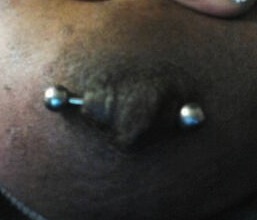 Nipple Piercing with Barbell--with excess scar tissue formation