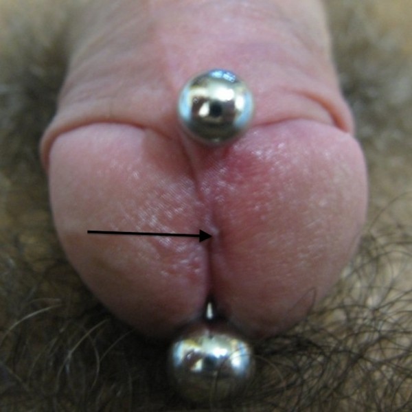 Prince Albert piercing on uncircumcised penis, depth indicated.