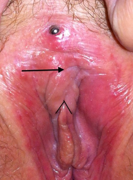 Marked image of botched VCH piercing
