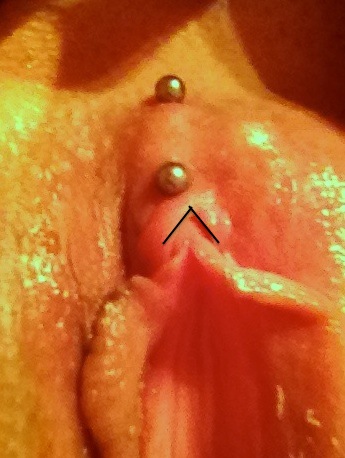 A Vertical Clitoral Hood (VCH) Surface Piercing Marked with Inverted-V