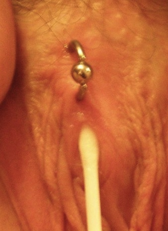 A Vertical Clitoral Hood (VCH) Surface Piercing with Q-tip test