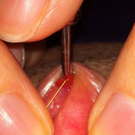 Clit Piercing Healing Process