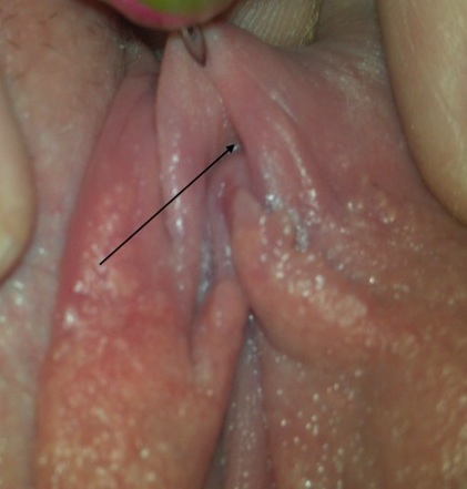Underside of VCH Piercing with arrow marked for optimal placement