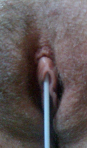 Q-tip Test for VCH Piercing