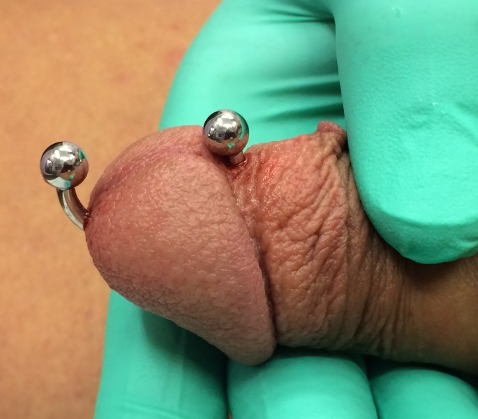 Prince Albert Piercing with Custom "C-Bar"