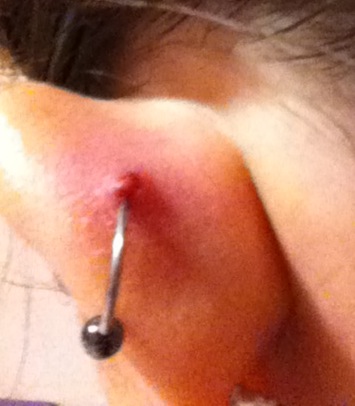 ear cartilage bump