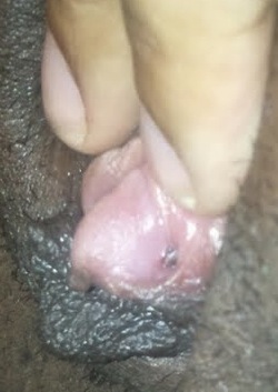 Botched Triangle Piercing (accidental clitoris piercing!)