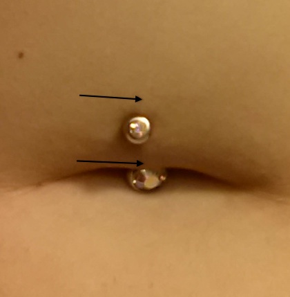 Alternative Placement Marked Alternative placement suggestion for navel piercing.