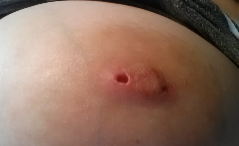 Other nipple after jewelry removal