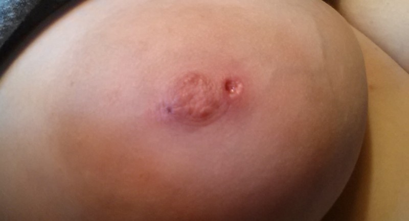 Nipple after barbell removal
