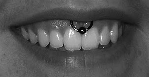 Smiley Piercing