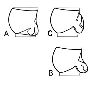 Traditional vs ergonomic pouch