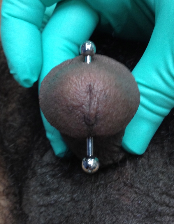 Apadravya piercing vertically through the glans (head) of the penis. 