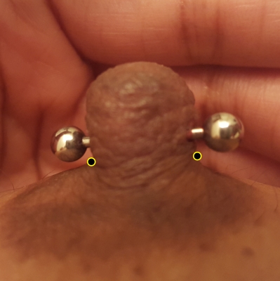 A woman with poorly placed piercing marked with appropriate placement at base of nipple