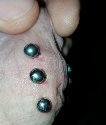 Three frenum piercings that appear to be healing normally