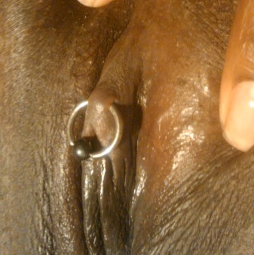 Poorly placed (very shallow) HCH piercing that must be abandoned