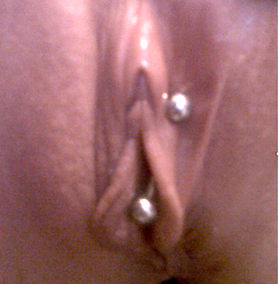Poorly placed inner labia piercing with inappropriate jewelry style and fit