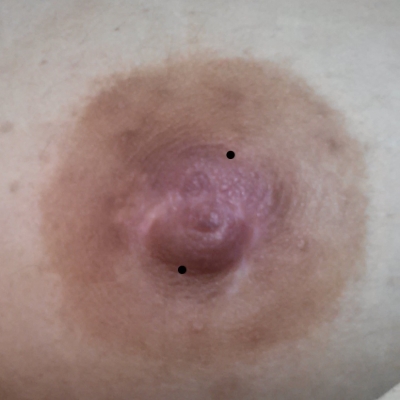 A scarred nipple marked for safer nipple piercing placement