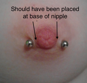 A poorly placed nipple piercing with inappropriate jewelry style - a curved bar