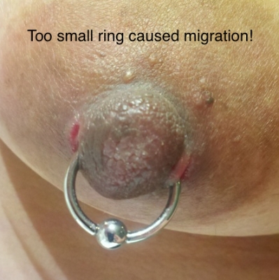 Nipple piercing migration from too-small ring