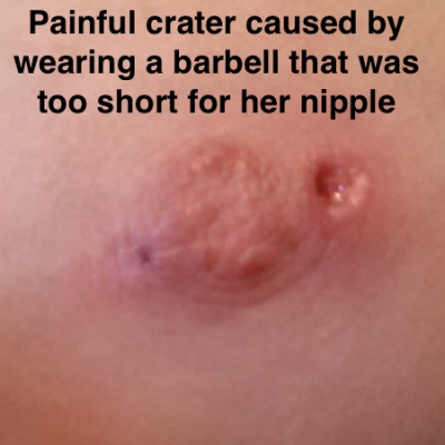 Crater in nipple caused by too-short barbell