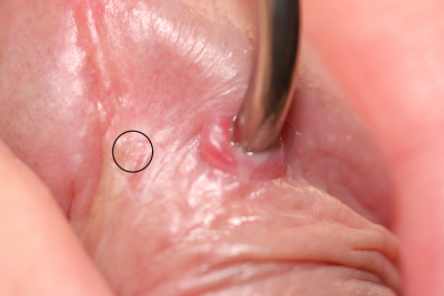 PA piercing having healing trouble, too angled, marked for appropriate placement