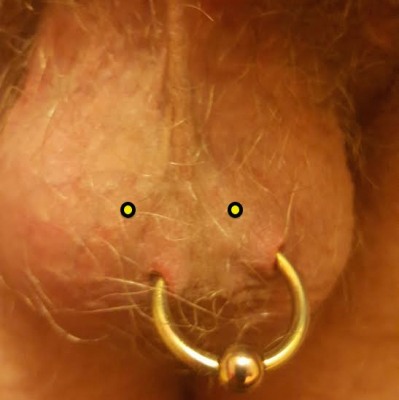 A poorly-placed scrotum piercing remarked