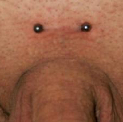 A surface piercing with barbell on the pubis (but not a "pubic piercing")