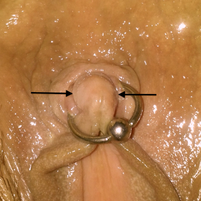 Arrows indicating where the poorly placed clitoris piercing should have been located
