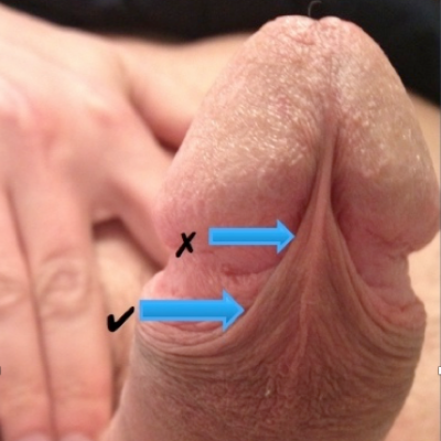 A penis marked with two arrows to show preferred placement for frenum piercings