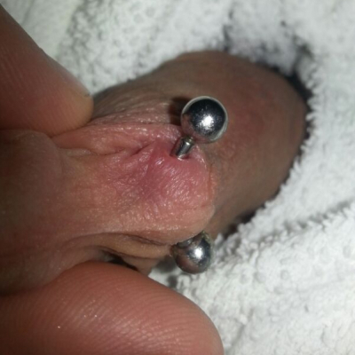 Irritated (red and swollen) frenum piercing with poor quality jewelry that has a gap between post and ball