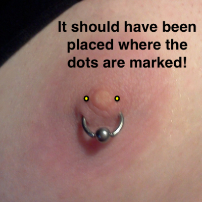 A poorly placed male nipple piercing marked where the piercing should have gone