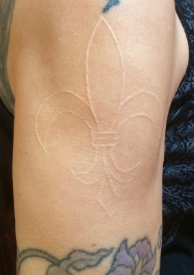My fleur de lis etching (scar) on my right upper arm in 2017