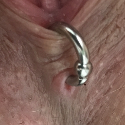 Fourchette piercing with a captive ring that is too small, and pinching on the tissue