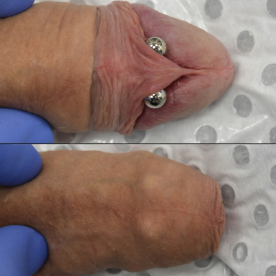 Frenum piercing on intact build, both exposed and within foreskin Joeltron Bament, Opal Heart, http://www.opalheart.com.au/ 
