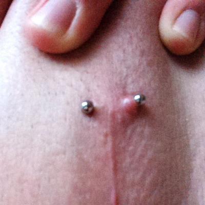 A guiche piercing experiencing excess scar tissue formation, which has rendered the jewelry too small