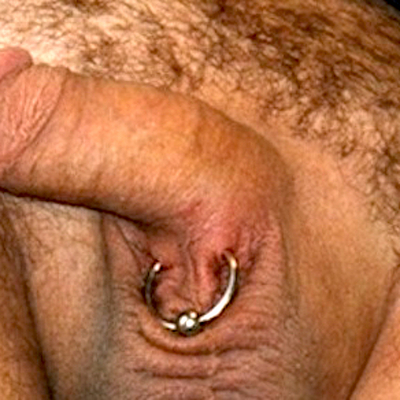 A fresh lorum with a captive bead ring experiencing normal swelling