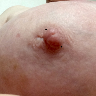 Another scarred nipple marked with alternative (diagonal) placement to avoid scar tissue