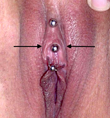 Botched "triangle" piercing with arrows showing where it should have been located