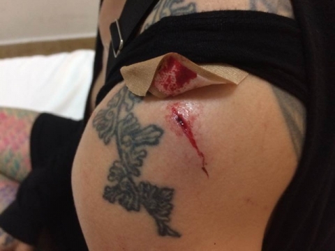 The fresh wound before suturing Thumbnail