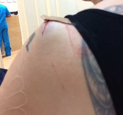 The hematoma that was surgically drained Thumbnail